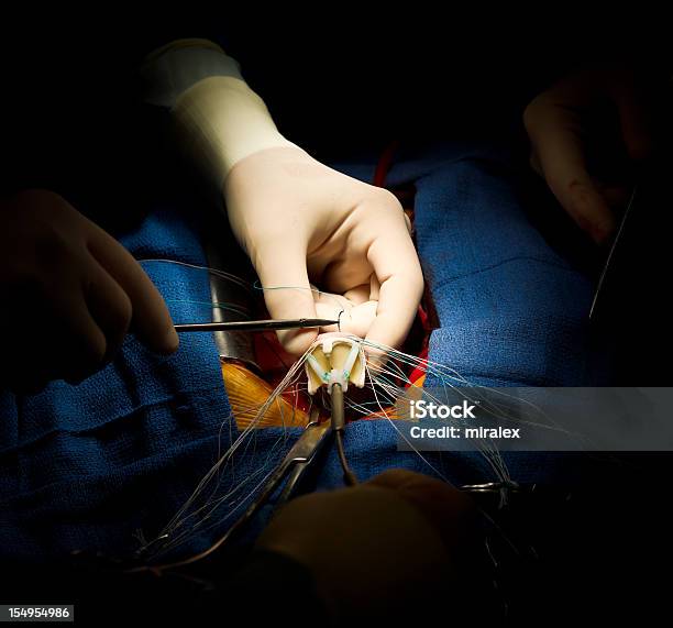 Heart Surgery Aortic Valve Replacement Stock Photo - Download Image Now - Heart Valve, Aorta, Healthcare And Medicine