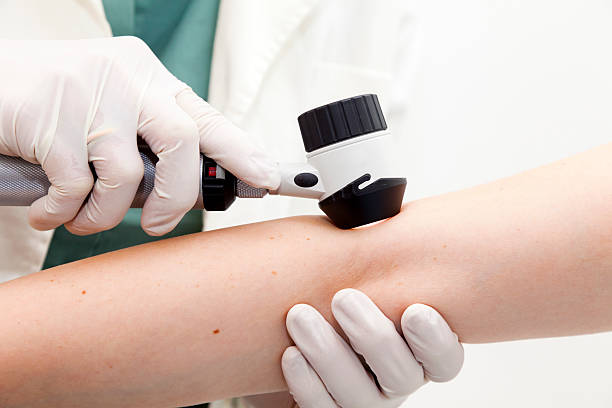 Dermoscopy Dermoscopy is a technique that is used worldwide to improve the accuracy of melanoma diagnosis. It is used extensively for mole screening and skin cancer diagnosis. skin exame stock pictures, royalty-free photos & images