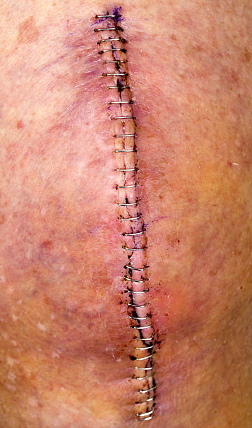 Knee replacement incision series  artificial knee photos stock pictures, royalty-free photos & images