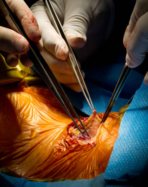 istock Vascular Surgery Carotid Endarterectomy 154962163