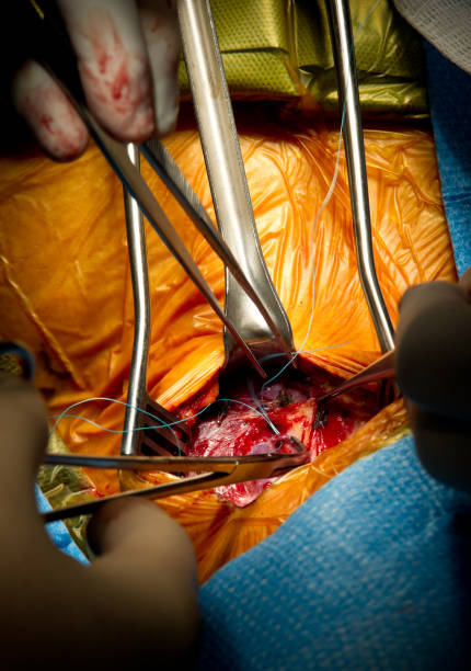 cirugía vascular endarterectomía carotídea anudar de venas branch - surgery human artery human hand carotid artery fotografías e imágenes de stock