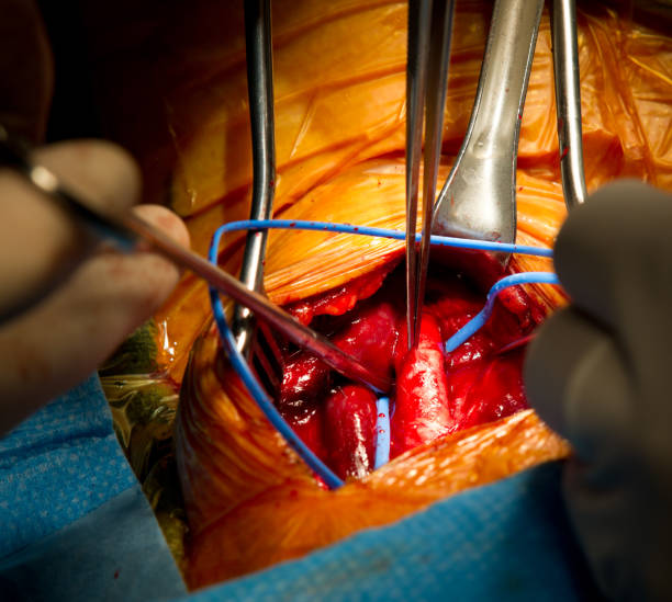 сосудистая хирургия каротидная эндартерэктомия - surgery human artery human hand carotid artery стоковые фото и изображения