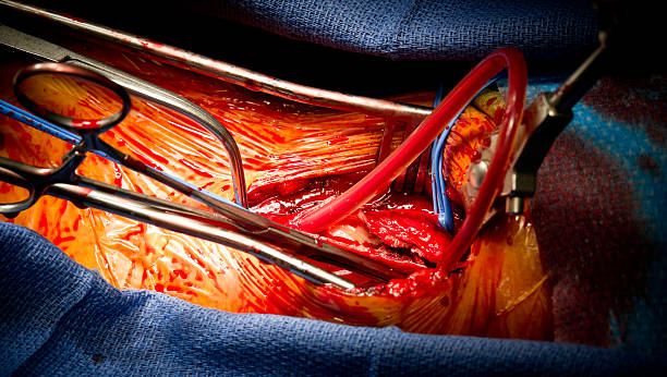 cirugía vascular endarterectomía carotídea - surgery human artery human hand carotid artery fotografías e imágenes de stock