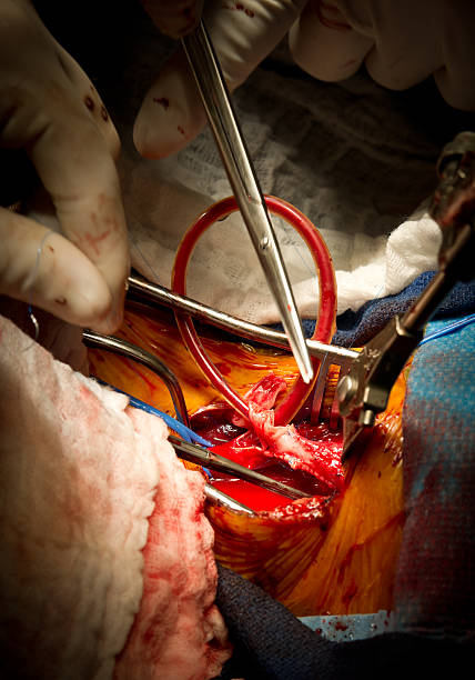 cirugía vascular endarterectomía carotídea - surgery human artery human hand carotid artery fotografías e imágenes de stock