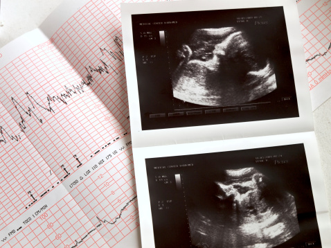 La ecografía y analuses del feto photo