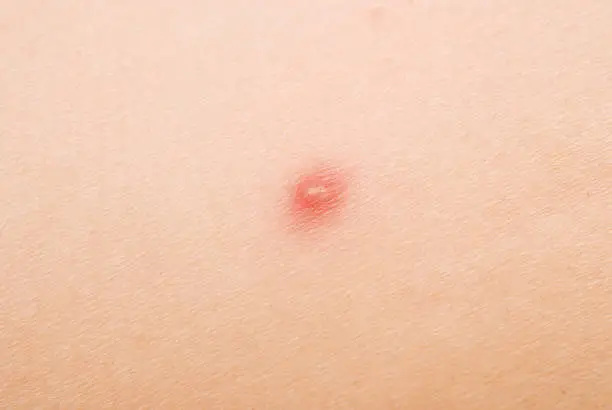 Photo of pimple