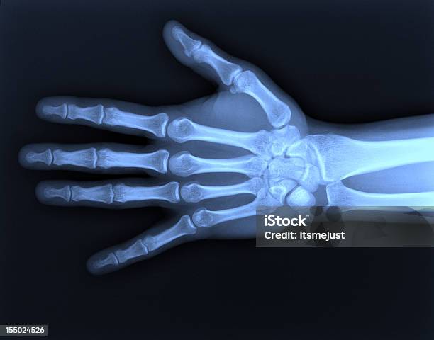 Xray Hand Stockfoto und mehr Bilder von Röntgenbild - Röntgenbild, Medizinisches Röntgenbild, Daten