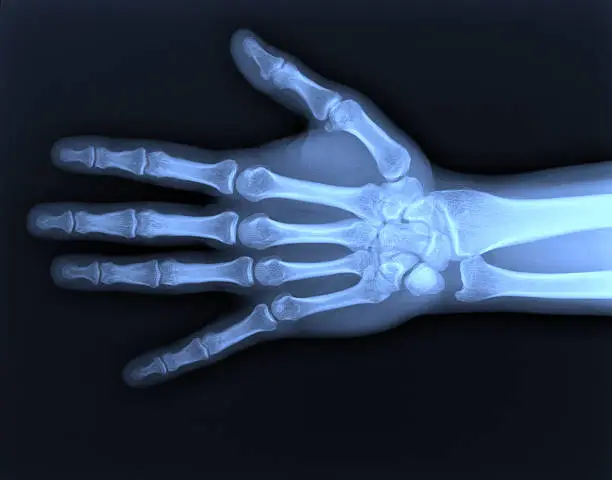 Photo of X-ray hand