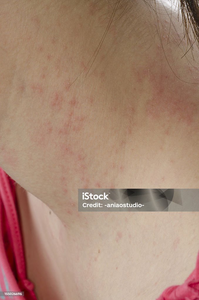 L'eczéma peau au niveau de l'encolure - Photo de Psoriasis libre de droits