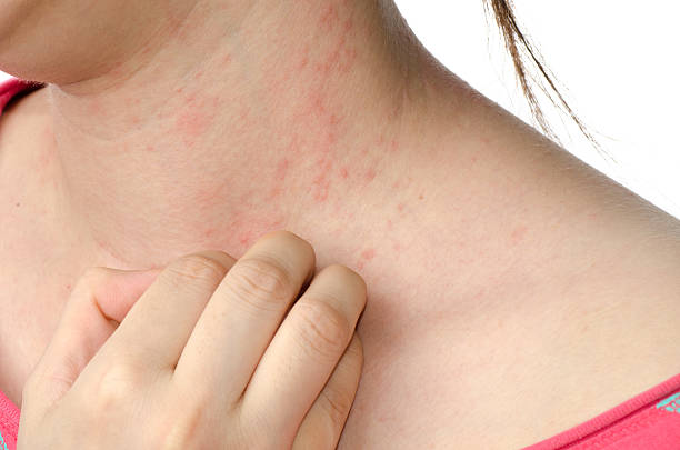 eczema haut am hals - ekzem stock-fotos und bilder