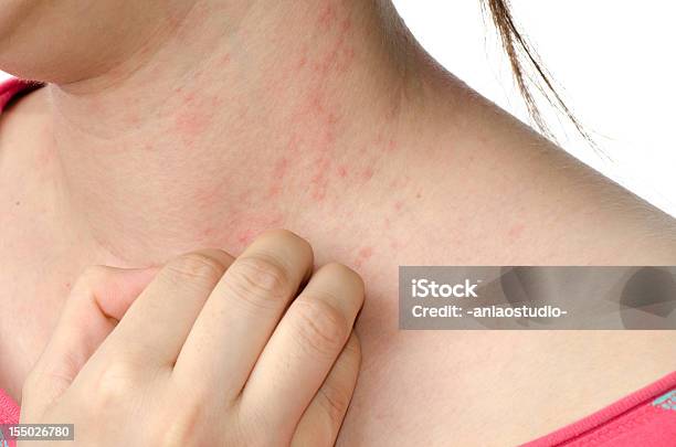 Eccema De La Piel En El Cuello Foto de stock y más banco de imágenes de Rascar - Rascar, Enfermedad de la piel, Eczema