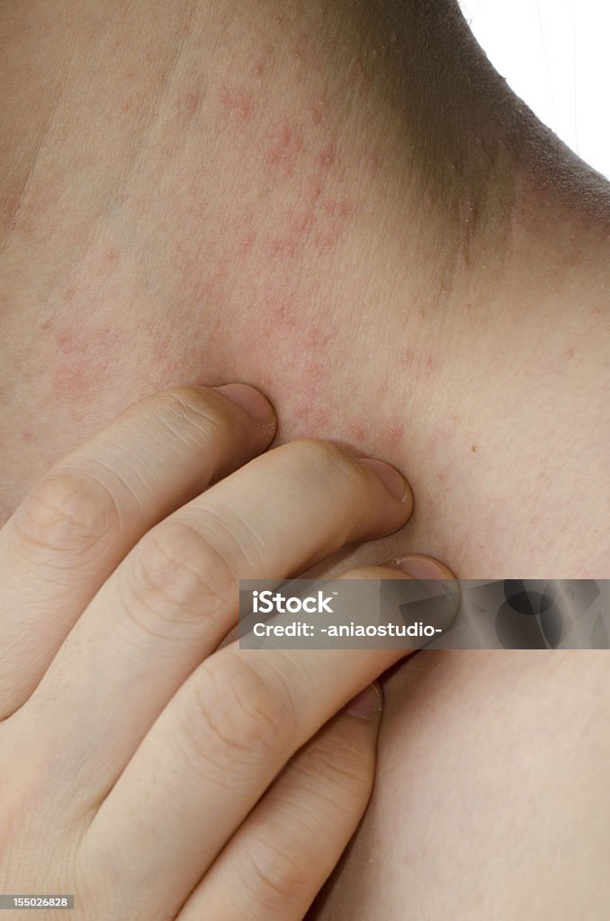 eczema Haut am Hals - Lizenzfrei Allergie Stock-Foto