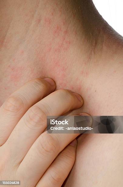 Eczema Haut Am Hals Stockfoto und mehr Bilder von Allergie - Allergie, Atopisches Ekzem, Baumwolltupfer