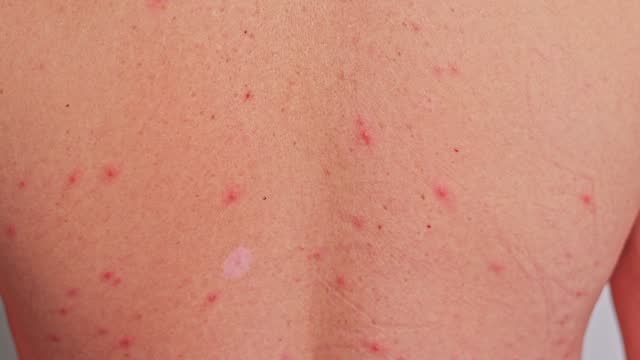 Man's back with acne, red spots, skin disease
