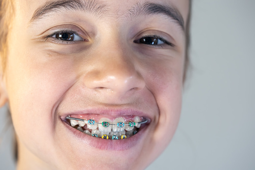 Teenage girl with braces on her teeth, close-up of a smile, perfect smile concept.