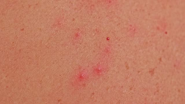 Man's back with acne, red spots, skin disease