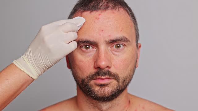 Man's forehead with acne, red spots, skin disease