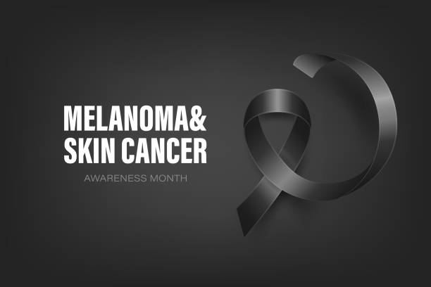 istock Melanoma, Skin Cancer Banner, Card, Placard with Vector 3d Realistic Black Ribbon on Black Background. Melanoma, Skin Cancer Awareness Month Symbol Closeup, May. World Melanoma Day Concept 1551164572
