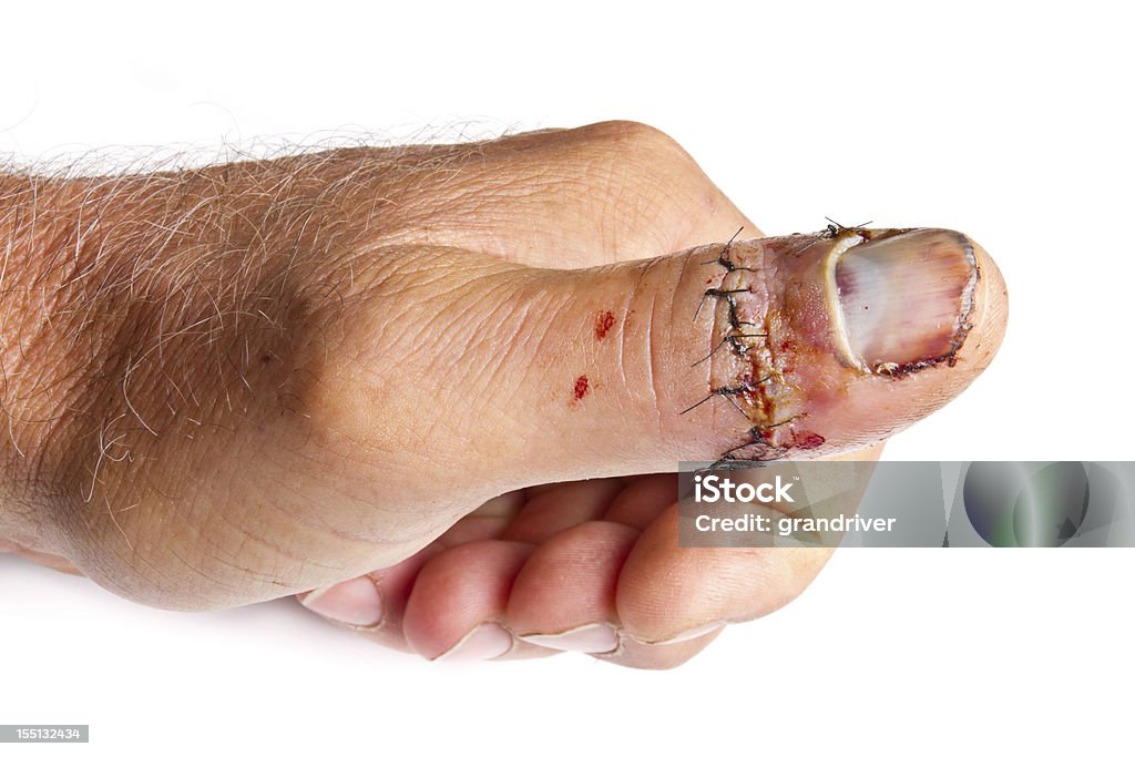 Injured Thumb Injured Thumb isolated on white with stitches Medical Stitches Stock Photo