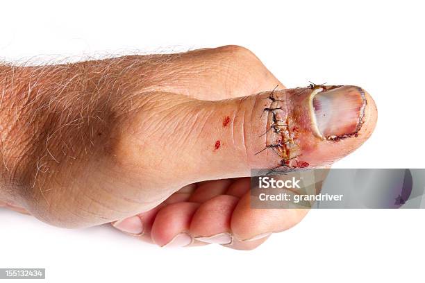 Injured Thumb Stock Photo - Download Image Now - Medical Stitches, Wound, Physical Injury