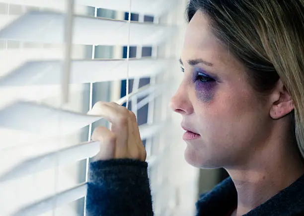 A young woman with a black eye, looking out a window.