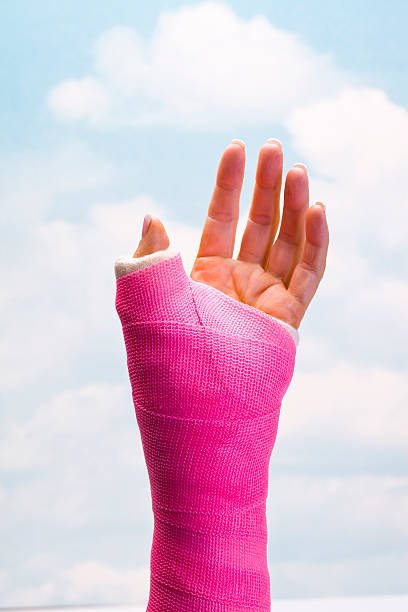 Hand In Cast Stock Photo - Download Image Now - Orthopedic Cast, Bone  Fracture, Broken Arm - iStock