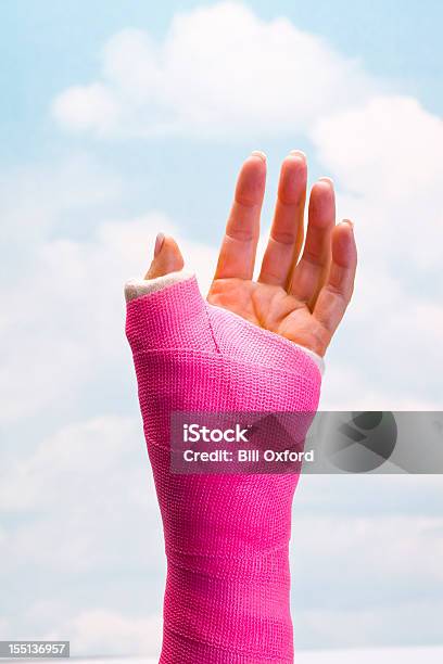 Hand In Cast Stock Photo - Download Image Now - Orthopedic Cast, Bone Fracture, Broken Arm