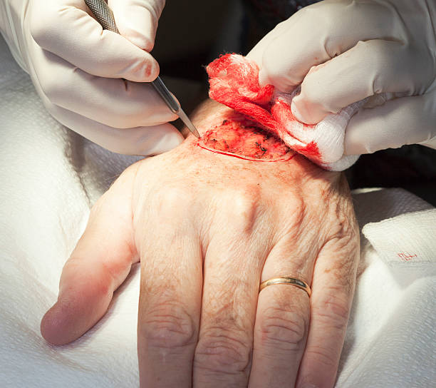 mohs 手術技術 - gauze scalpel surgeon healthcare and medicine ストックフォトと画像