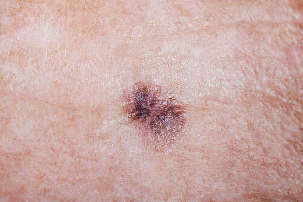 Lentigo Maligna Melanoma Lentigo Maligna Melanoma on a mans forehead after a biopsy. There are two stitches holding the biopsy site together. jodijacobson stock pictures, royalty-free photos & images