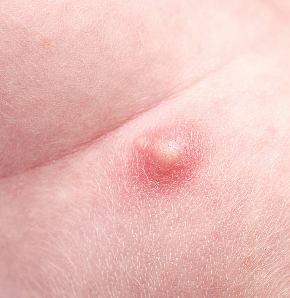 pimple close up of pimple abscess stock pictures, royalty-free photos & images