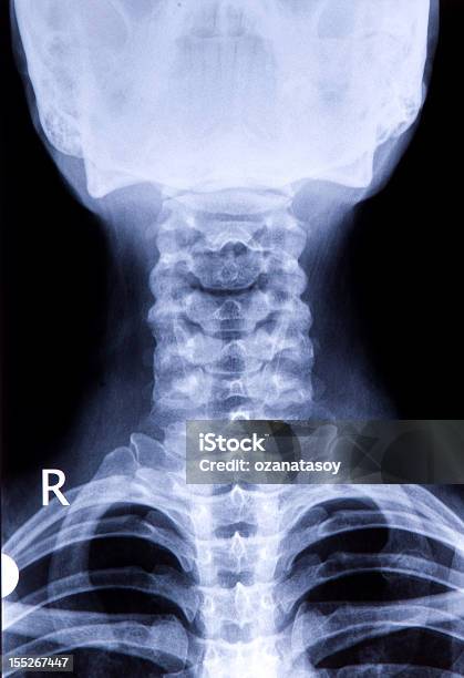 Radiografia Lato Del Collo - Fotografie stock e altre immagini di Immagine a raggi X - Immagine a raggi X, Vista posteriore, Anatomia umana