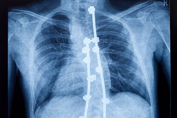 x-ray d'une colonne vertébrale arrondi - scoliosis photos et images de collection