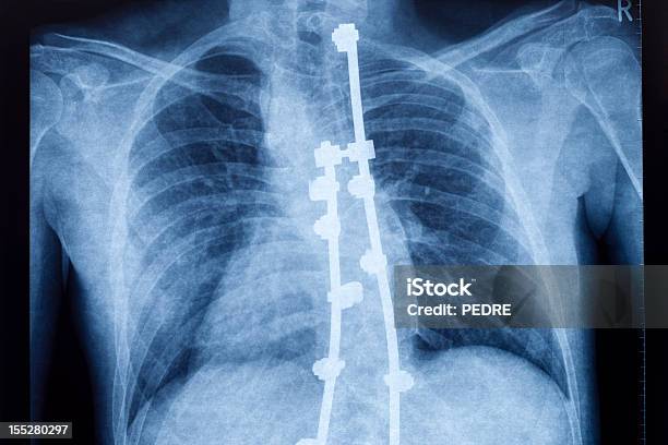 Raiosx De Coluna Vertebral Curvada - Fotografias de stock e mais imagens de Cirurgia - Cirurgia, Escoliose, Coluna vertebral - Parte do corpo