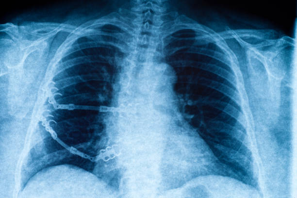 istock X-ray of a curved vertebral column 155280332