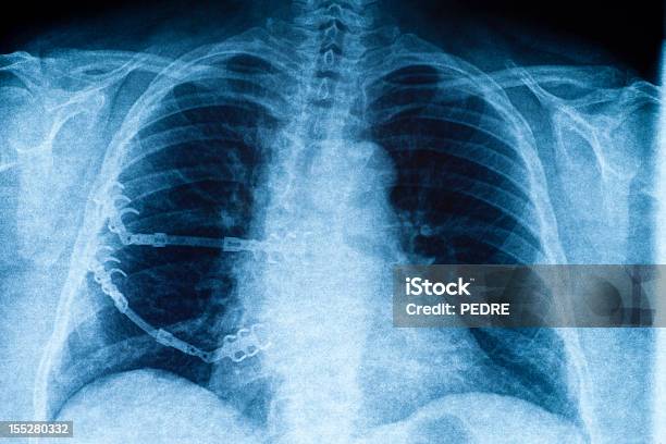 Xray Of Округлый Позвоночного Столба — стоковые фотографии и другие картинки Операция - Операция, Сколиоз, Рентгеновский снимок