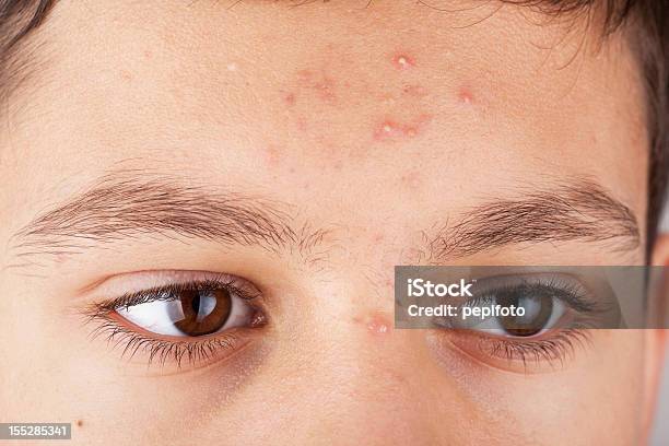 Teenager Haut Probleme Stockfoto und mehr Bilder von Akne - Akne, Hautfleck, Menschliches Gesicht