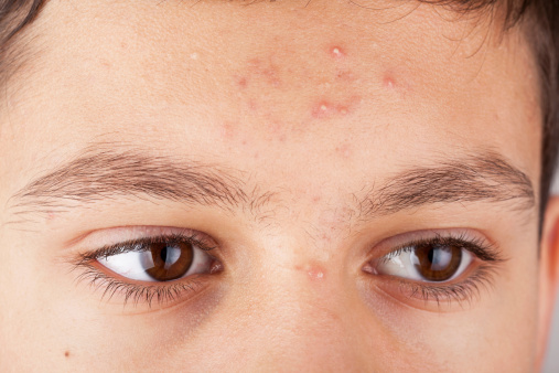 Forehead of a teenage boy with pimples 