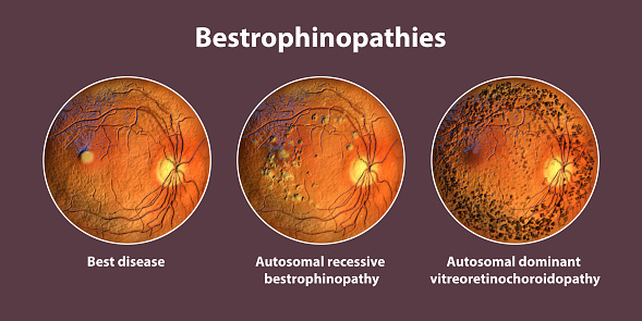 Bestrophinopathies, inherited retinal disorders caused by mutations in the BEST1 gene, 3D render. Best disease, autosomal recessive bestrophinopathy, and autosomal dominant vitreoretinochoroidopathy
