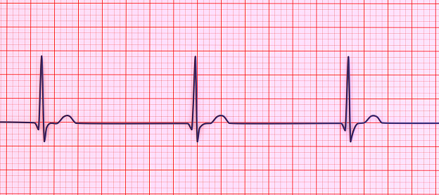 Electrocardiogram example of a normal 12-lead sinus rhythm, close up