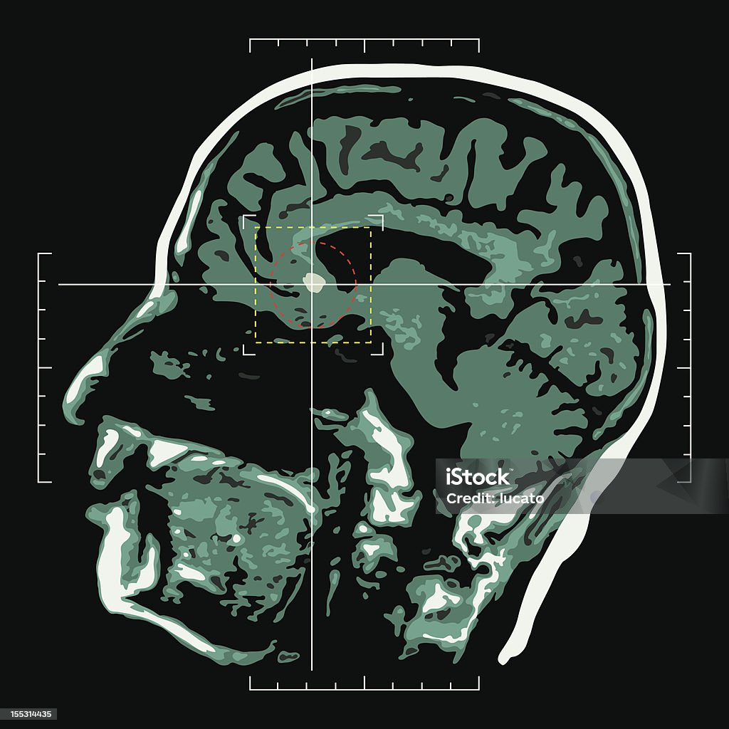 Mózg-target - Grafika wektorowa royalty-free (Obrazowanie magnetyczno-rezonansowe)