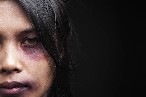 la violencia doméstica víctima - cardenal lesión física fotografías e imágenes de stock
