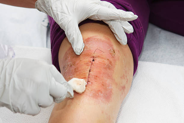 Nurse is changing bandage to a patient after knee operation Nurse is changing bandage to a patient after knee operation...visible allergic reaction on skin stitches wound surgery nurse stock pictures, royalty-free photos & images