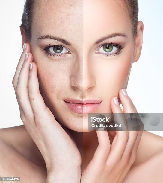 Vor Und Nach Stockfoto und mehr Bilder von Menschliches Gesicht - Menschliches Gesicht, Akne, Frauen