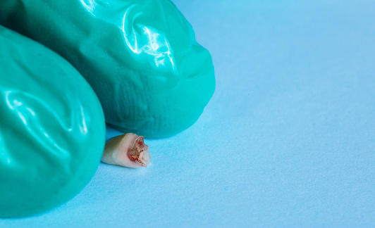 A dentist in a green glove holds a milk tooth on a blue background. Extraction of teeth in children, pediatric dentistry.