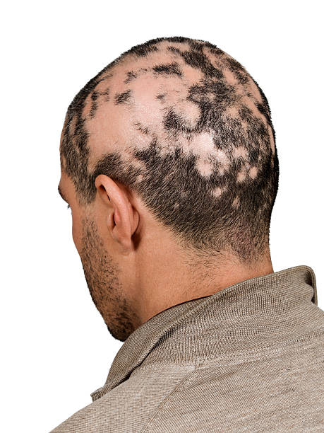 alopecia - bald patch ストックフォトと画像