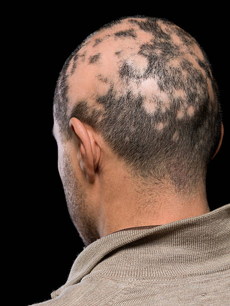 alopecia - bald patch ストックフォトと画像