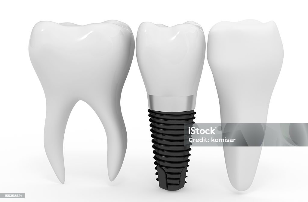 Implantes dentários - Royalty-free Dentadura Foto de stock