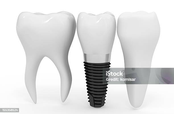 Implantes Dentários - Fotografias de stock e mais imagens de Dentadura - Dentadura, Dente Humano, Equipamento Dentário