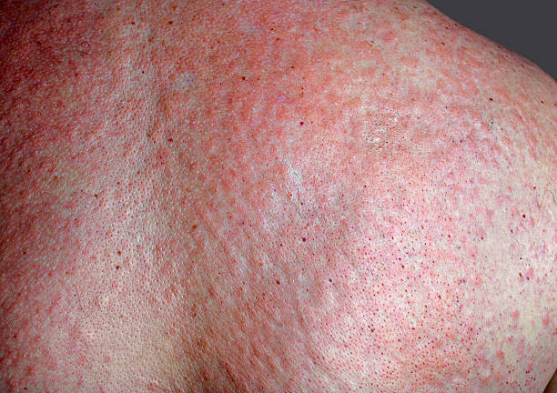 Rash Rash on the back of a male after waxing keratosis pilaris stock pictures, royalty-free photos & images