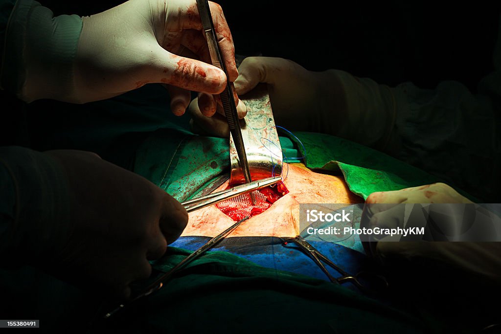 Cirurgia de Hérnia Inguinal - Royalty-free Estrutura Entrelaçada de Metal Foto de stock